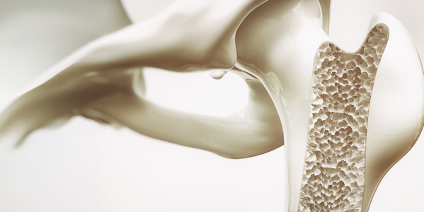 ¿Qué hormonas causan osteoporosis?